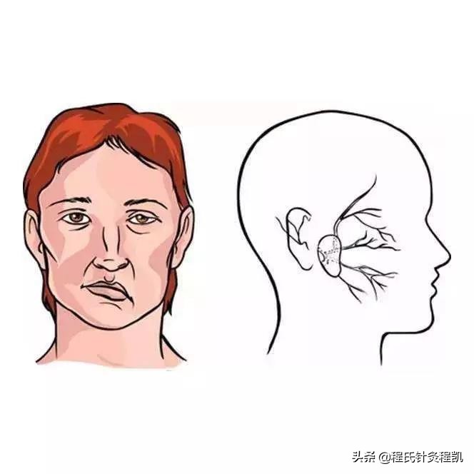 面瘫面神经炎中医调理方法,面神经炎中医针灸穴位图片