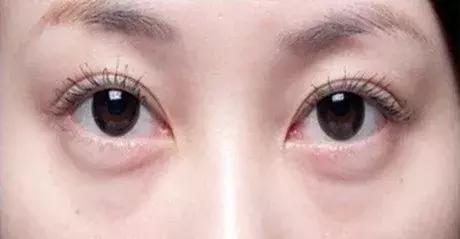 改善眼袋仅980元不开刀让你更出众,消除眼袋细纹大概多少钱