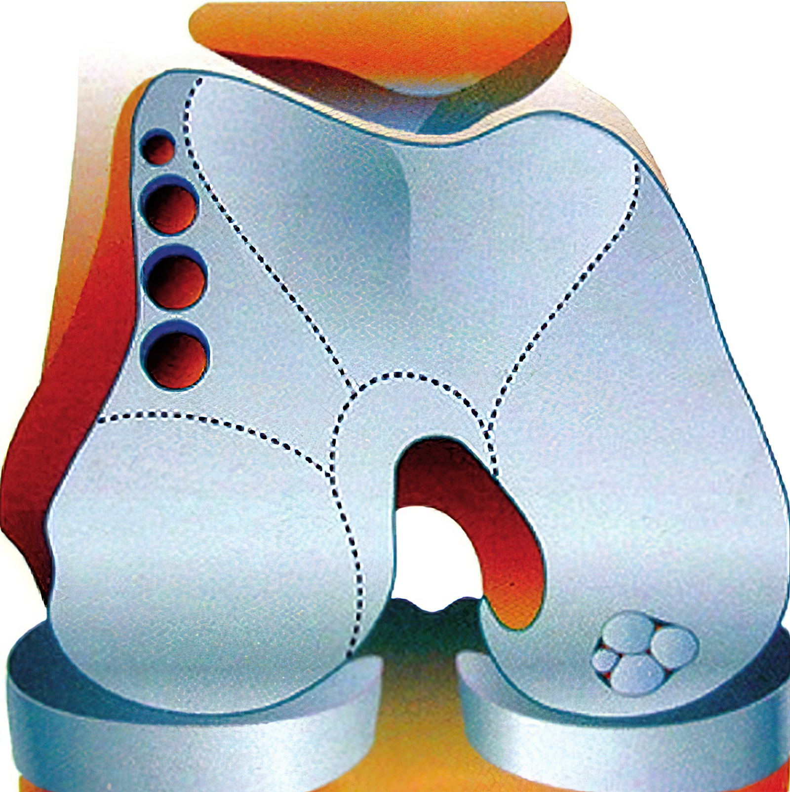 软骨损伤膝关节炎最好治疗方法,膝关节骨性关节炎修补