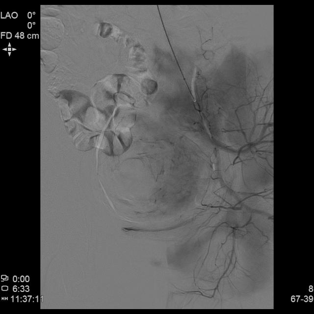 宫外孕保守治疗显示子宫腺肌症,子宫腺肌病保守治疗无效怎么办