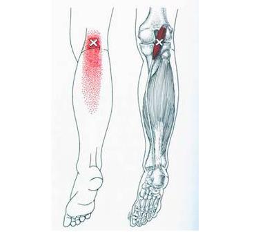 膝关节腘窝疼痛的锻炼方法,腘窝疼痛连带大腿小腿肌肉痛