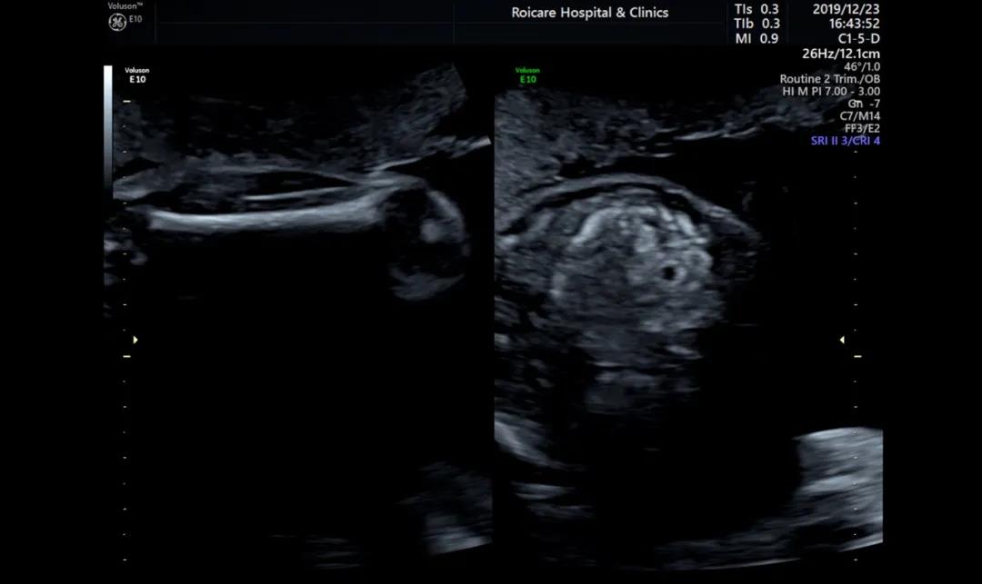 胎儿超声强回声,胎儿超声超细讲解视频