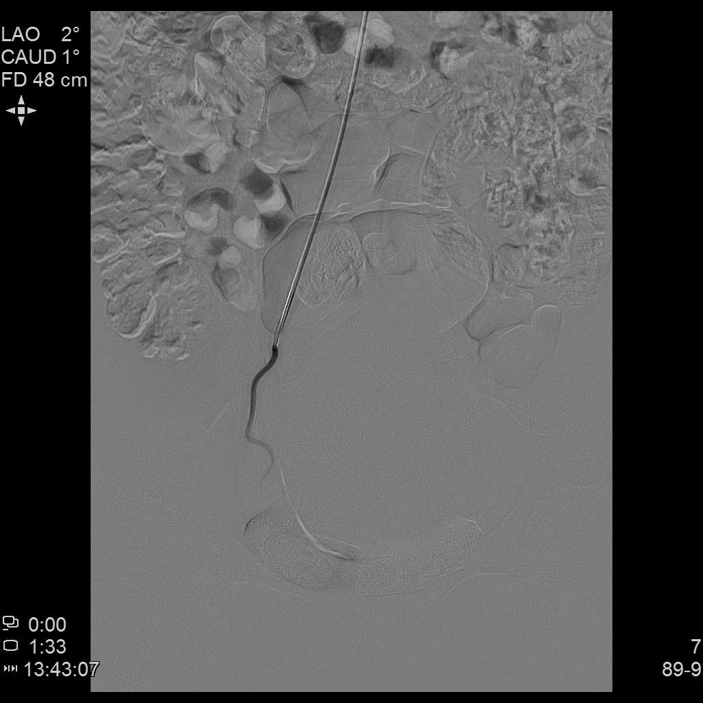子宫腺肌症「不死的癌症」——介入栓塞来帮忙