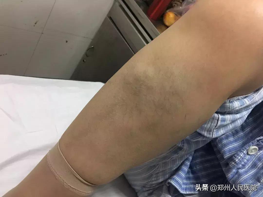 蚯蚓腿需要治疗吗,蚯蚓腿不开刀治疗