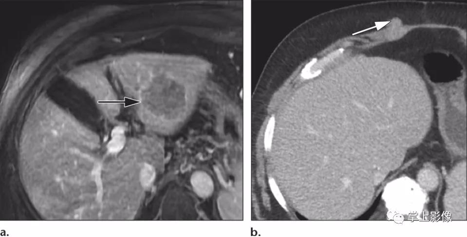 腹壁病变诊断思路,腹部影像诊断读片入门视频