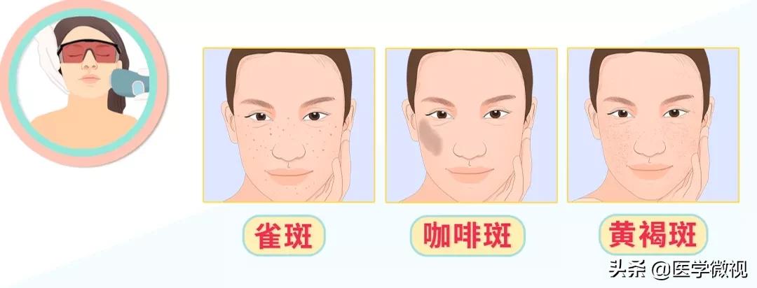 猕猴桃女孩腋下脱毛,猕猴桃女孩轻松脱毛的救星