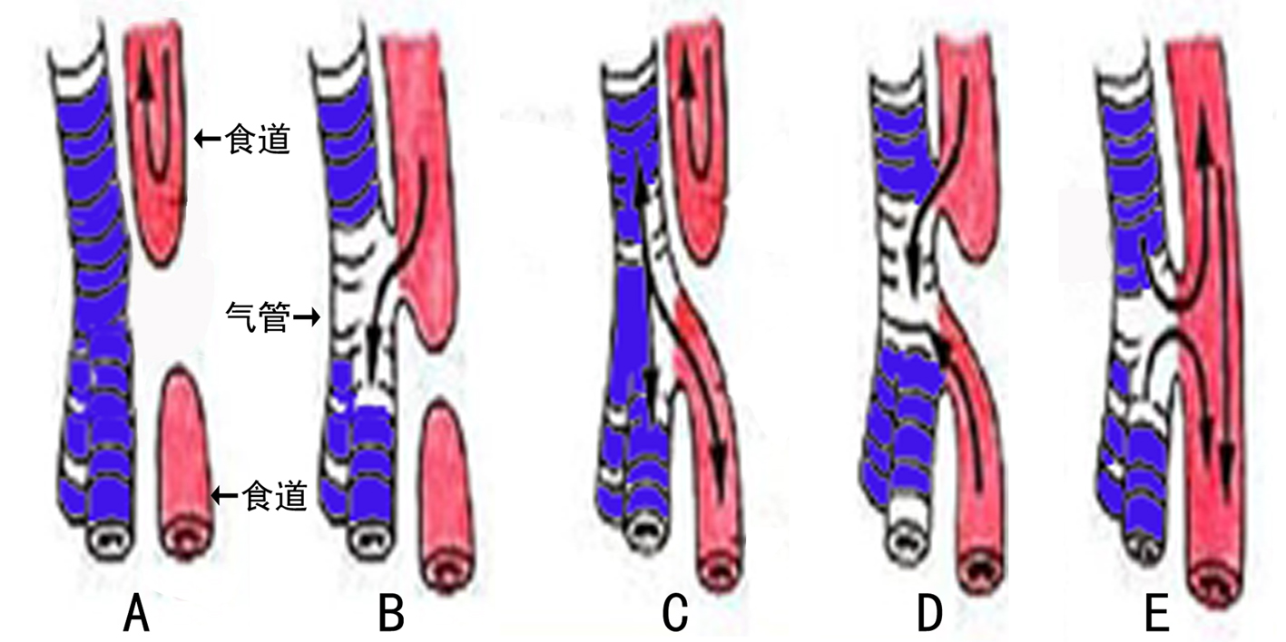 明明白白做超声28-1胎儿消化系统畸形：食道闭锁