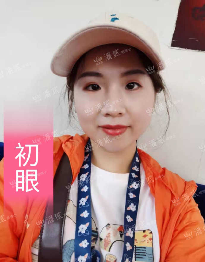 双眼皮手术后眼神凶狠是什么原因,双眼皮手术后显凶