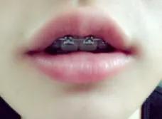 杭州牙齿矫正口腔医院,杭州牙齿矫正哪里最便宜