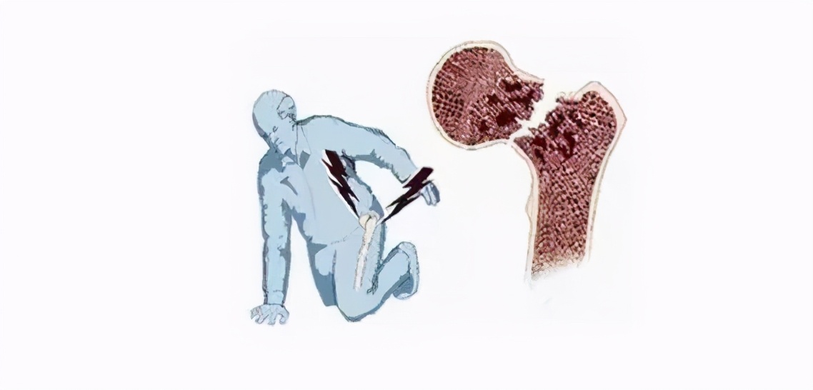 这种骨折致残率、死亡率高到难以想象!全球30%发生率在中国