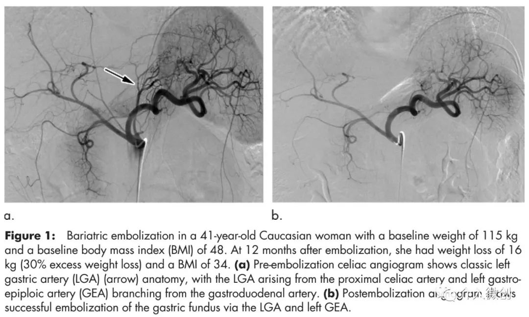 减肥缩小胃容量的5个方法,减肥先缩胃的正确方法