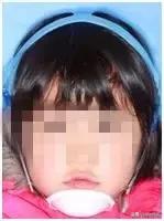 乳牙地包天会自动好吗,乳牙地包天矫正活动器