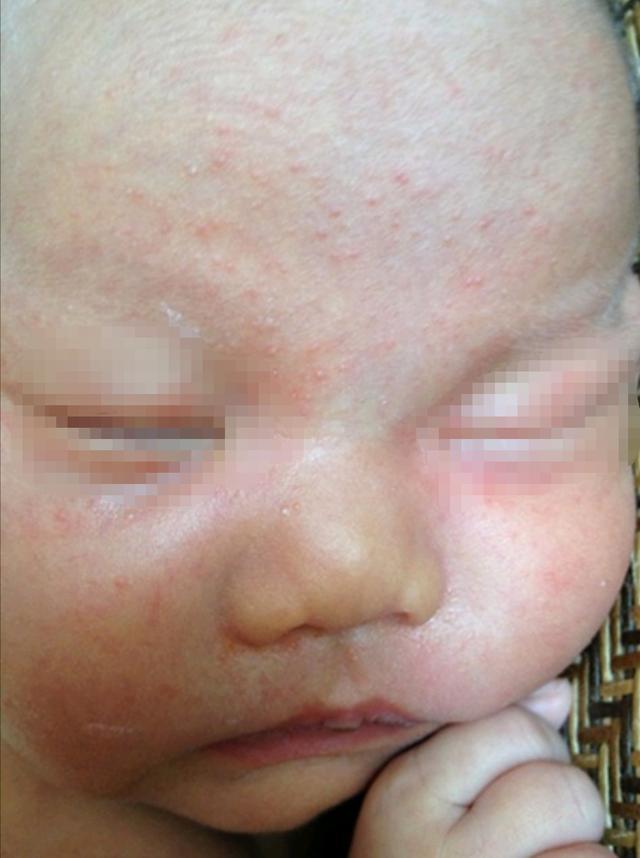 宝宝湿疹护理全过程手法,幼儿湿疹怎样正确干预