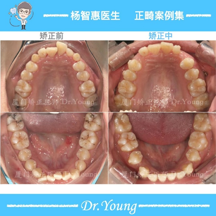 牙齿矫正牙列不齐案例,厦门儿童牙齿矫正龅牙前突