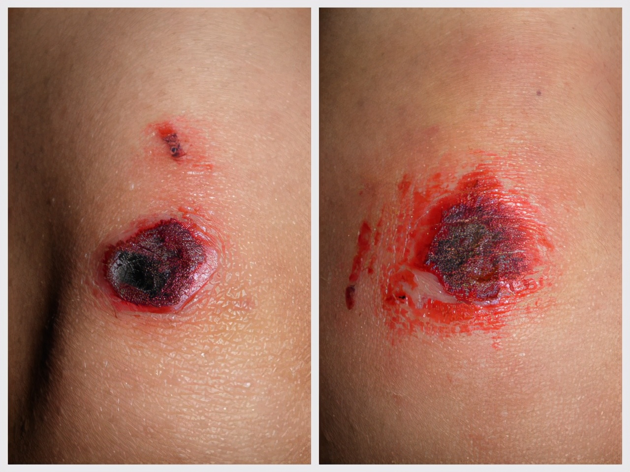 骨质增生有没有可能治好,骨科患者常见误区