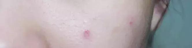 黑头粉刺怎么去都消除不了,去闭口黑头粉刺最有效的方法