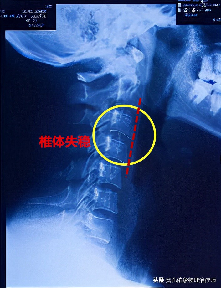 脖子按摩起来咯噔咯噔的怎么回事,转动脖子咔咔响什么原因