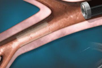 手术的时候医生对你做了什么,手术时切了一片肺叶