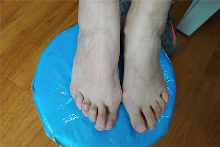 得了类风湿有彻底治愈的案例吗,类风湿治疗要趁早