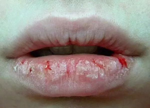 孕期不小心把嘴巴咬破了怎么办,怀孕初期嘴不小心咬破了