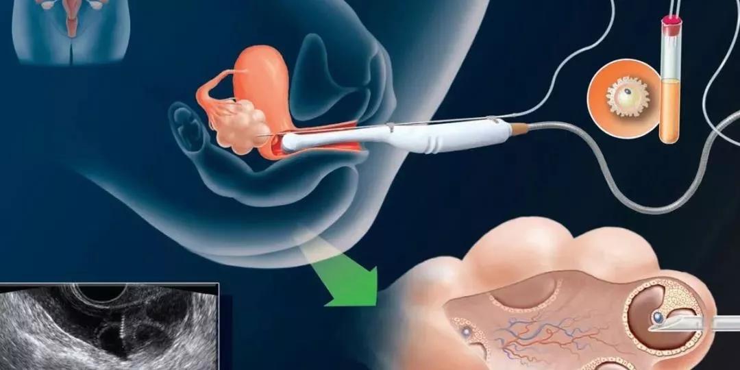 取卵真的特别疼吗?