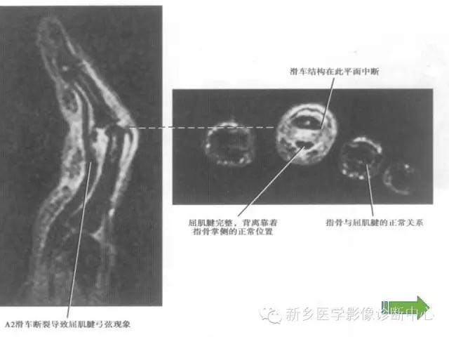 单只手指磁共振,手指用磁共振能做出来结果吗