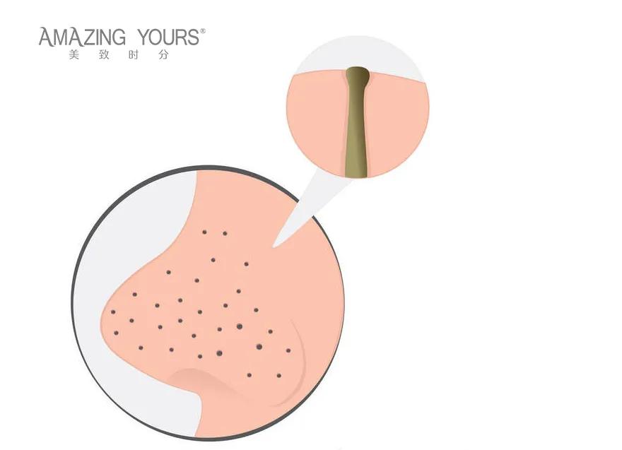 卸妆油可以去黑头吗｜美致时分