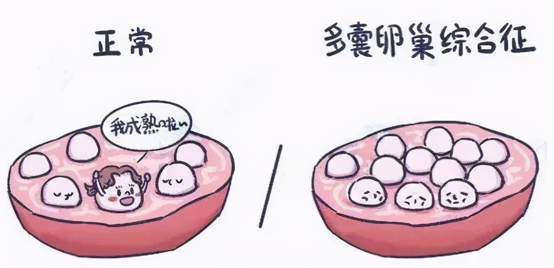 多囊卵巢综合征需要终身吃药吗,双侧卵巢多囊样改变吃药会好吗