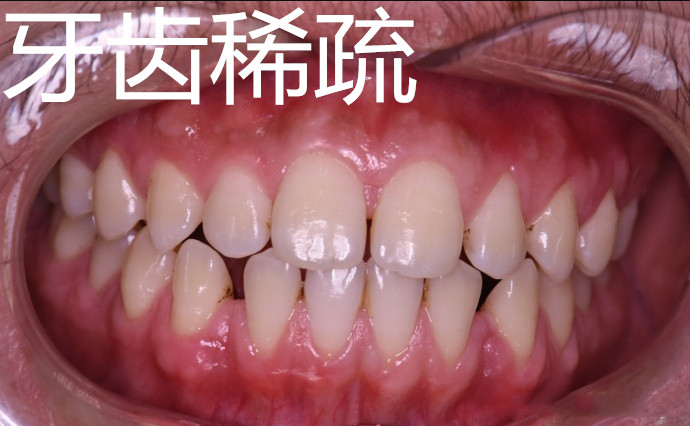 30岁还可以牙齿矫正吗,30岁牙齿矫正一般多少钱