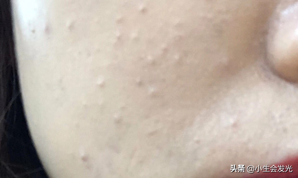 闭口怎么形成的怎么去,闭口一般是怎么形成的