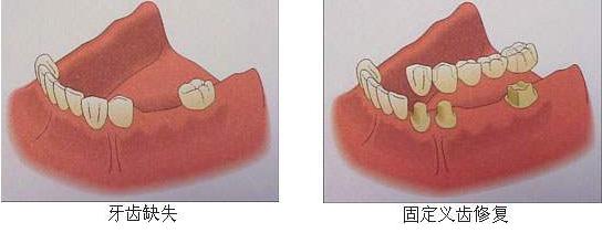 单颗门牙缺失牙桥修复,固定桥修复缺失牙
