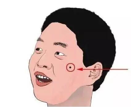 郝医生的治疗效果,全切祛痣一个月的疤痕效果