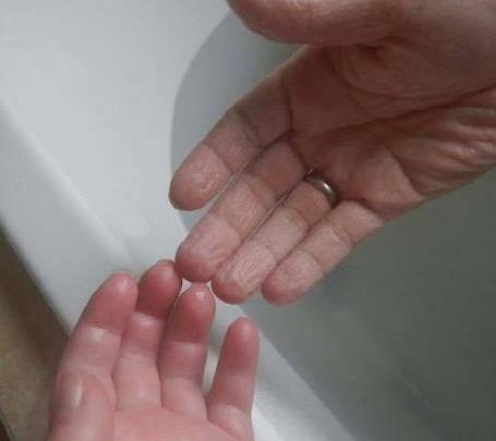 为什么手指泡水后凹凸不平,手指泡水后变腐烂怎么办