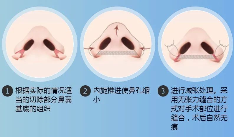 鼻翼缩小内缩和外缩的区别,鼻头缩小和鼻翼缩小是一个手术吗