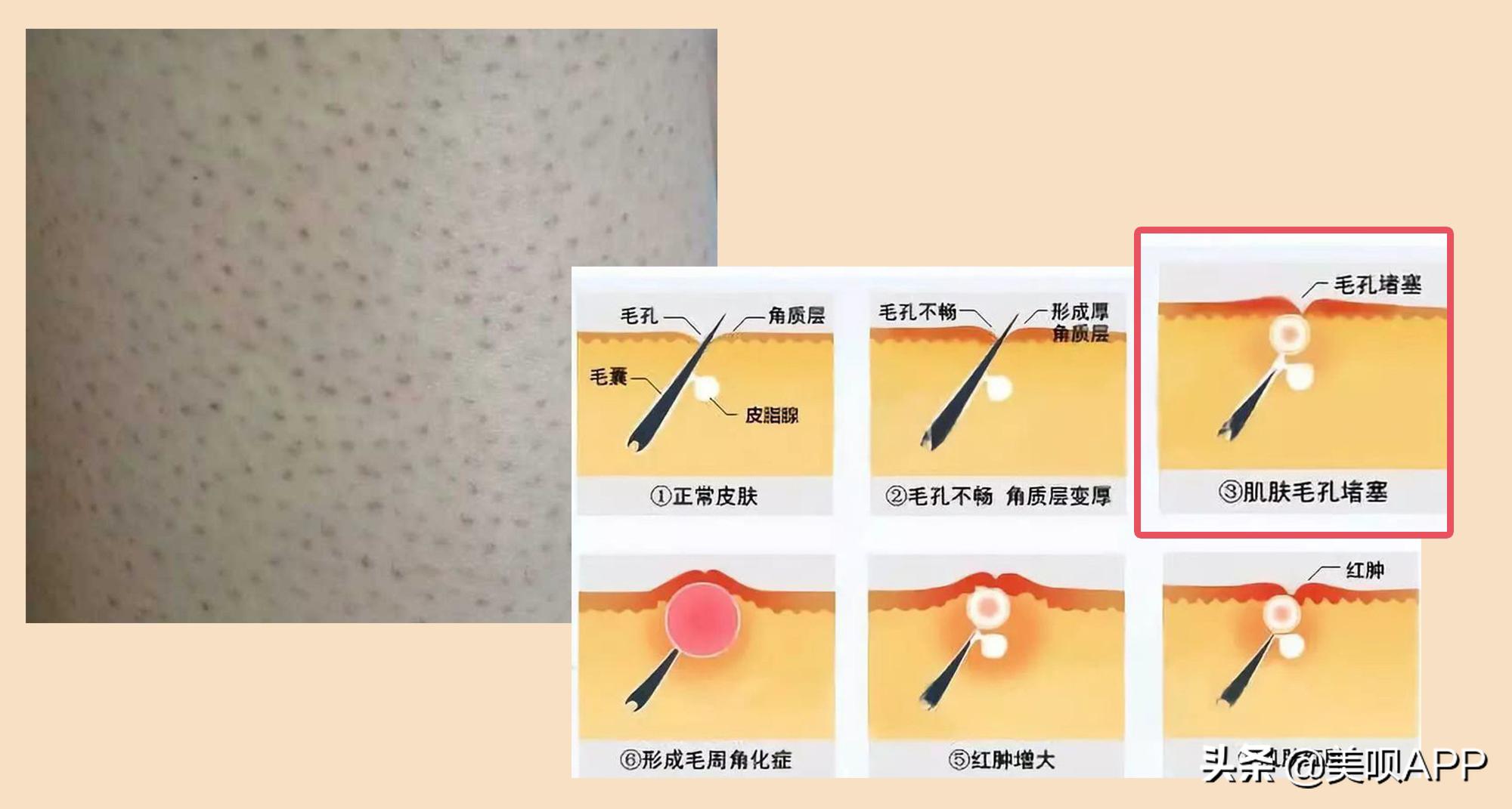 春季鸡皮肤大作战!去毛周角化也要分种类好吗?