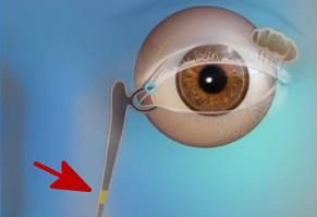 为什么我的眼里常含泪水？因为泪道病对我“爱”得深沉