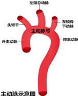 致命的主动脉夹层,主动脉夹层最危险的生命杀手