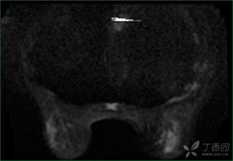 乳腺结节有消散的病例吗,一份完整的乳腺增生病例