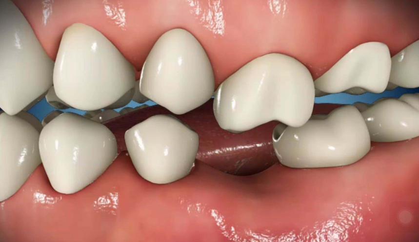 补牙学问,补牙真的是小洞不补大洞吃苦吗