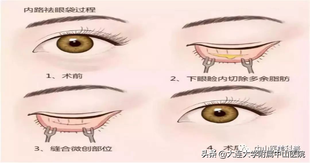 你有没有被自己的眼袋困扰过,关于眼袋的科普在这里