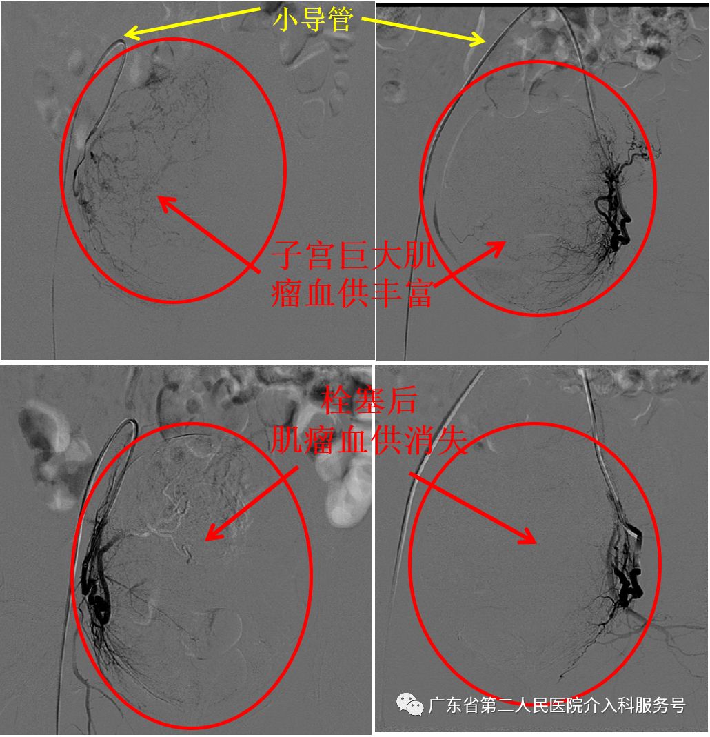 子宫肌瘤引起“大姨妈”排山倒海，淋沥不净……针眼妙方解除烦恼