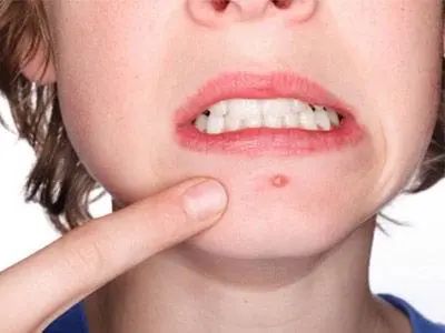 女士下巴反复长痘痘怎么治,成人下巴反复长痘痘怎么治