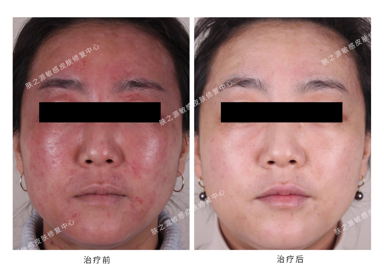 正品ray面膜,药监局曝ray面膜含激素