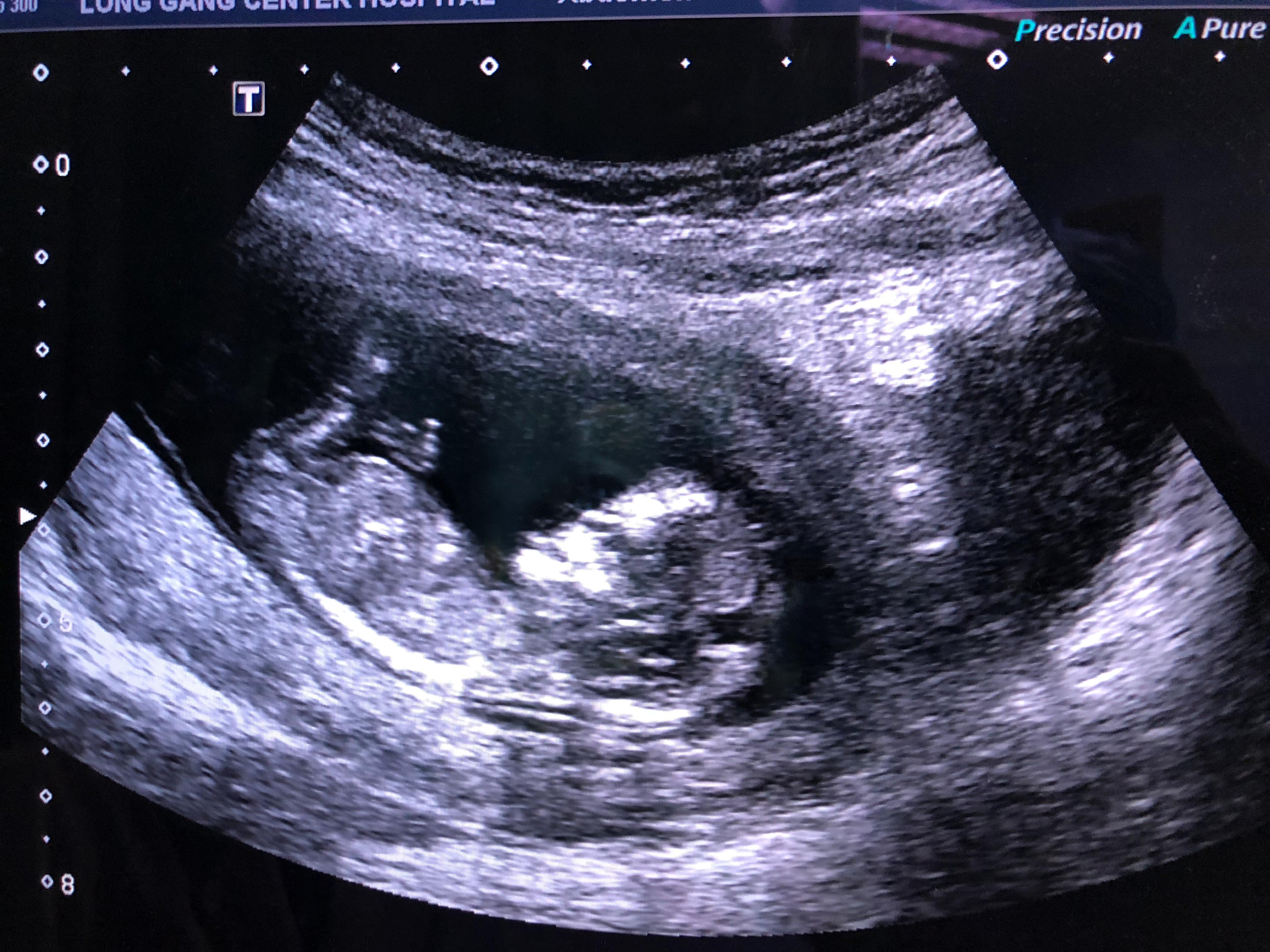 小超人测试卷,早孕完全攻略妇产科医生良心分享