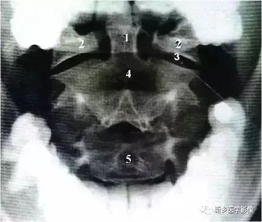 肘关节x线解剖,颈椎x线图片与讲解大全