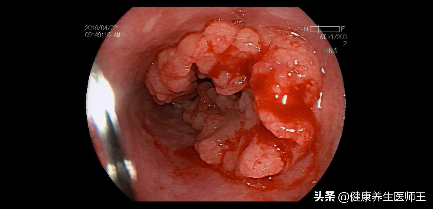食管癌四期化疗能延长多久生命,食管癌手术后健康宣教