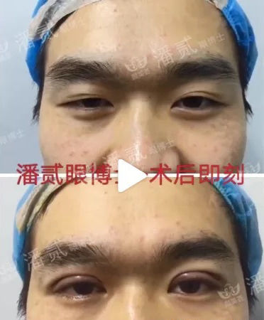 韩式三点式双眼皮手术很疼吗,韩式三点双眼皮做的不好看