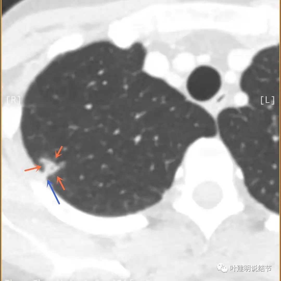 临床诊断孤立性肺结节,空洞型结节一般是什么性质
