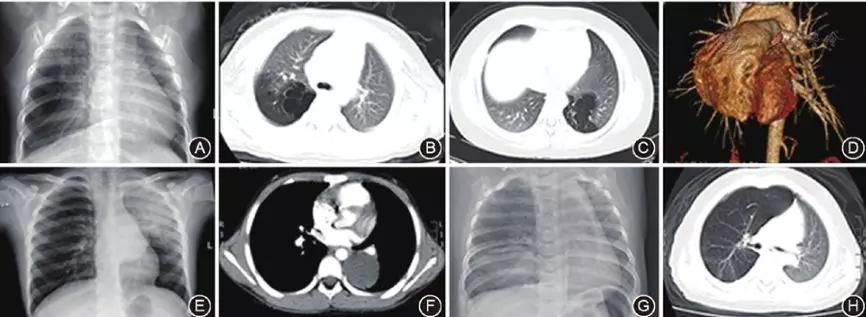 呼吸性疾病,呼吸内科间质性肺疾病