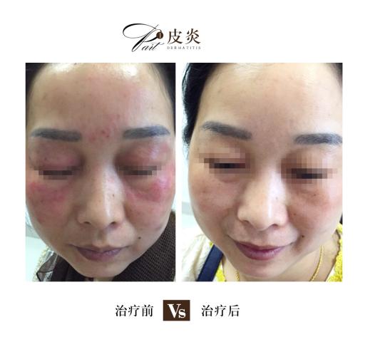 湿疹与湿疹样皮炎区别,湿疹与湿疹皮炎区别